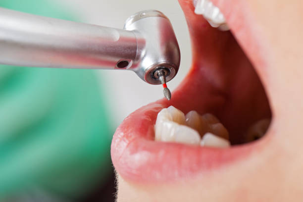 Best Chipped Tooth Repair Near Me  in Wyanet, IL